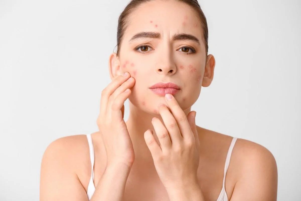 Acne treatment